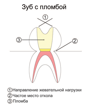 Описание: Описание: "Откололся зуб" - частое осложнение после удаления нерва и реставрации пломбой