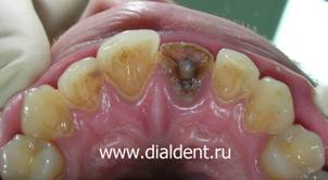 Темный травмированный зуб. Зуб не подлежит восстановлению 