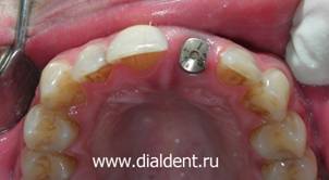 Зуб удален и одновременно на место удаляемого зуба установлен зубной имплант Astra Tech. Хирург-имплантолог Алавердов В.П.