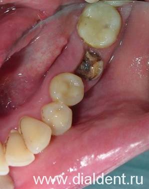 Имплантация зубов. Нежизнеспособный зуб