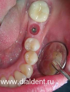 Имплантация зубов. Установлен имплантат.