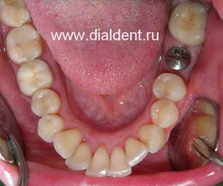 Имплантация зубов. Установлен формирователь десны.