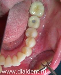 Имплантация зубов. Металлокерамическаяч коронка прикручена к имплантату и закрыта пломбой.