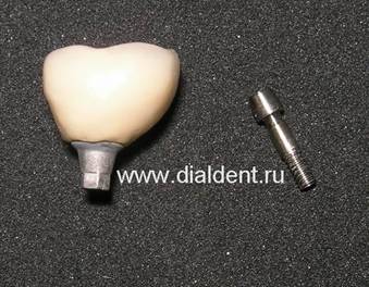 Имплантация зубов. Металлокерамическая коронка с винтовой фиксацией к имплантату.