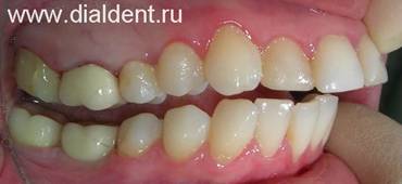 Имплантация зубов. Зуб восстановлен
