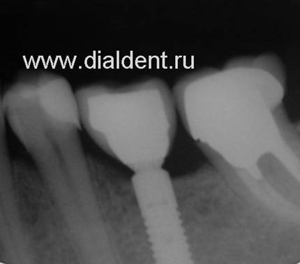 Имплантация зубов - лучший метод замещения отсутствующих зубов.