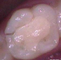 Откол стенки зуба. Частое осложнение, когда после удаления из зуба нерва, зуб реставрируется пломбой.