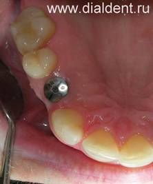 Имплантат зуба. Зубной имплантат