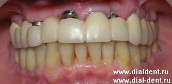 Описание: не ходите без зубов. При правильном планировании, даже при длительном стоматологическом лечении, делаются временные зубные протезы.