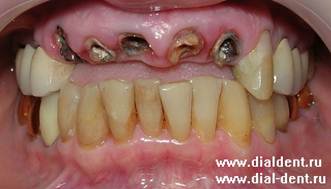Описание: вид зубов до лечения