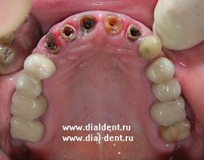 Описание: Сильно разрушенные зубы подлежат удалению