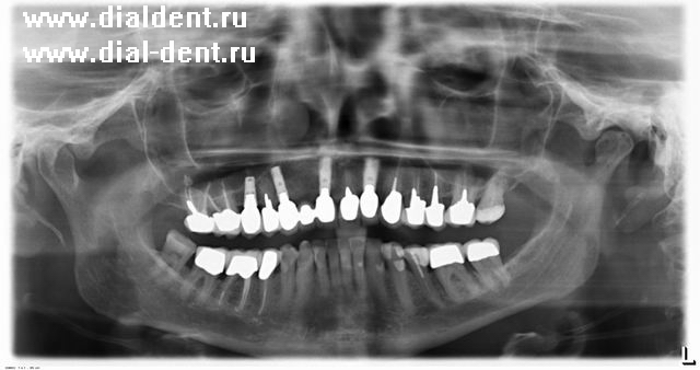 Описание: Снимок зубов, показывающий идеальное выполнение работы. Установлено четыре имплантата в верхнюю челюсть.