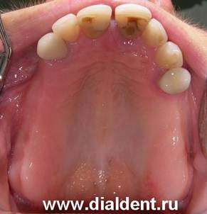 Описание: Щель между зубами, отсутствие зубов, протезирование в Диал-Дент