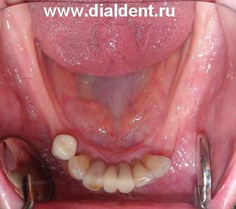 Описание: отсутствие зубов, протезирование в Диал-Дент