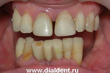 Описание: Щель между зубами
отсутствие зубов, протезирование в Диал-Дент