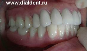 Описание: Металлокерамика зубы
