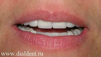 Описание: Протезирование зубов металлокерамикой