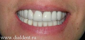 Описание: Протезирование зубов металлокерамикой