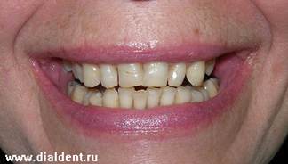 Описание: Улыбка до реставрации зубов
