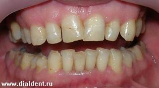 Описание: Передние зубы до реставрации