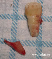 Перелом корня зуба. Выбитые зубы