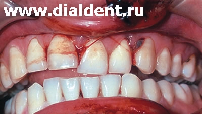 Травмы можно избежать или снизить ее тяжесть если применять зажитные зубные капы от специалистов "Диал-Дент"