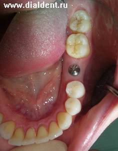 Описание: Имплантация зубов.