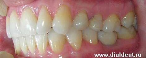 Описание: Протезирование зубов - метод имплантации 