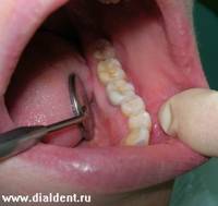 Описание: Естесственный вид имплантированного зуба.
