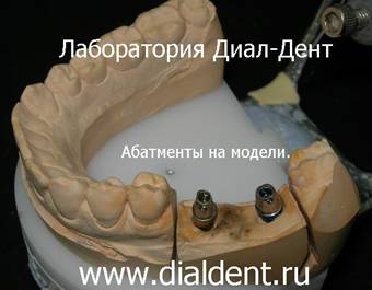 Имплантация зубов на Павелецкой