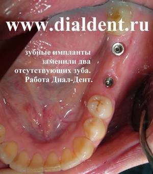 Зубные импланты. Диал-Дент