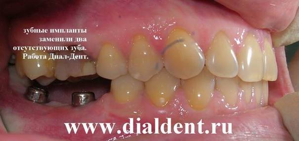 Зубные импланты. Диал-Дент