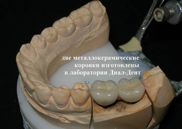 зубные импланты и металлокерамика