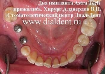 Описание: Установлены два зубных импланта