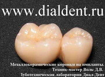 Описание: стоимость металлокерамики на имплантат 15000 рублей