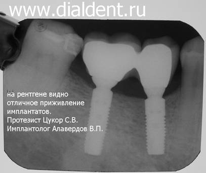 имплантация зубов метро Павелецкая