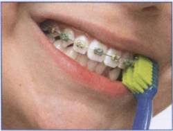 Ортодонтическая зубная щетка для чистки брекетов всегда в наличии в Диал-Дент
