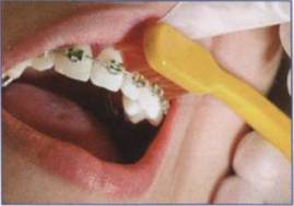 ортодонтическую зубную щетку всегда можно купить в Диал-Дент