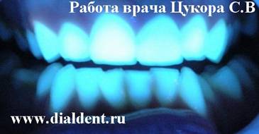 Реставрация зубов, элитная стоматология, эстетическая реставрация зубов, эстетическая стоматология