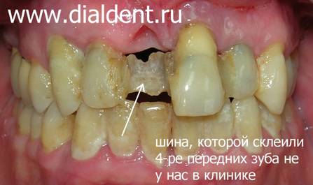 Шинирование зубов выполнено без правильного лечения пародонтита. Шинирование зубов не эффективно