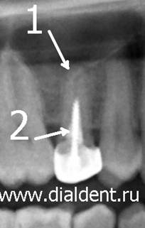 Плохо пролеченные каналы в зубе. Диагностический рентгеновский снимок в Центре "Диал-Дент"