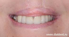 Протезирование зубов при расщелине губы твердого и мягкого неба. Выполнено в Центре "Диал-Дент"