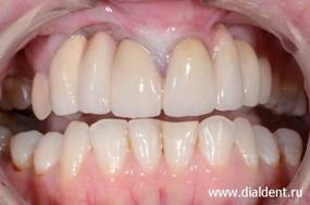 Протезирование зубов в сложных случаях расщелин губ и неба. Центр "Диал-Дент"