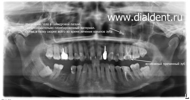 Панорамный снимок зубов и компютерная томграфия в Диал-Дент